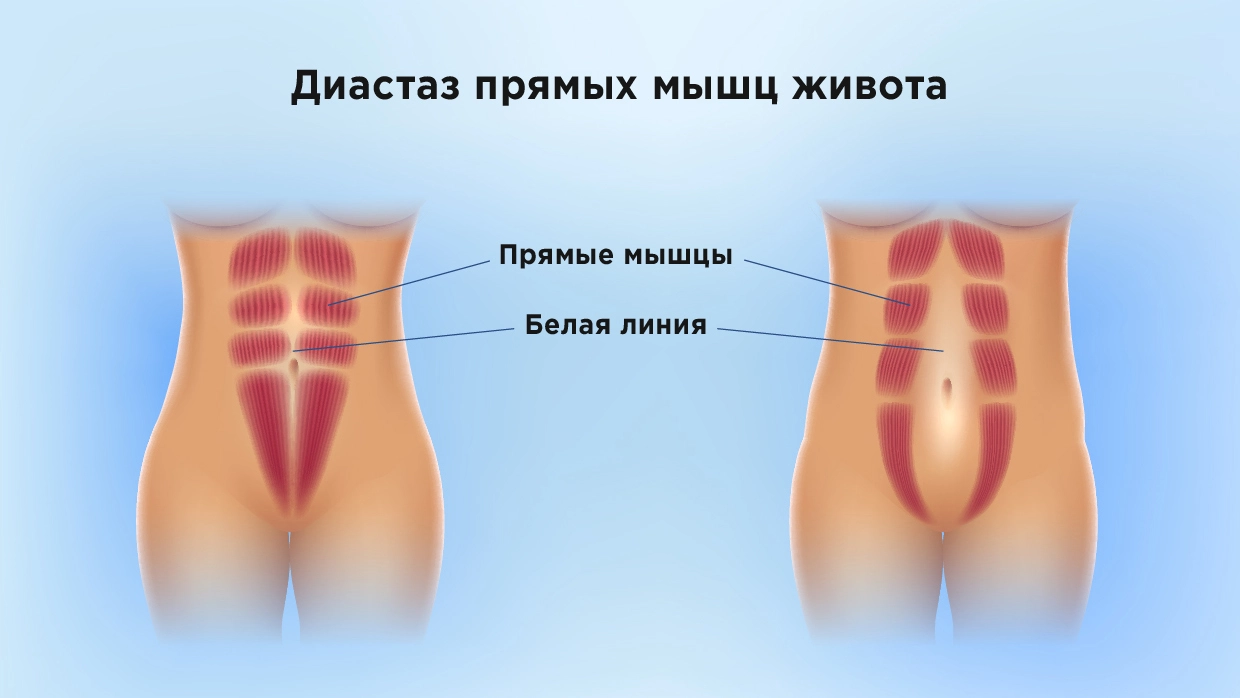 Как вернуть плоский живот после родов?